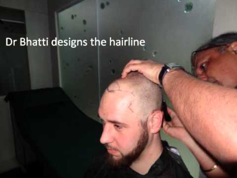 hair transplantation in India - http:www.hairtransplant-india.org Anagen selective FUE hair transplant (the Golden Harvest) gives better early results than in cases wherein all phases of gr...