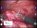 Robotic Partial Nephrectomy: 4 Arm Technique
