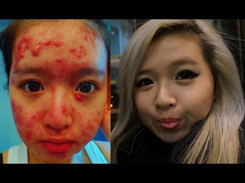 My Acne Story - Accutane FAQ