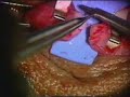 vasectomy reversal
