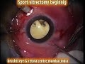 Vitrectomy for Proliferative Diabetic Retinopathy