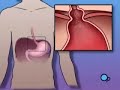 PreOp® Minimal: Hernia - Hiatal Open Repair Surgery Hernia