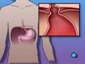 PreOp Patient Education: Hernia - Hiatal Open Repair Surgery 1