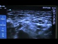 Ultrasound-guided Continuous Interscalene Block