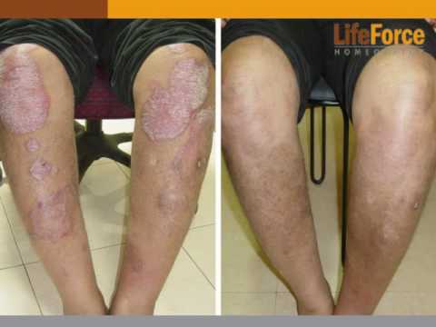how to treat guttate psoriasis