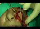 maxillofacial surgery video preview 14