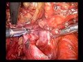 Prostate Cancer -Laparoscopic Extended Pelvic Nodes Excision Prostate Cancer -Laparoscopic Extended Pelvic Nodes Excision