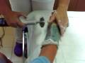 ablation de la resine
