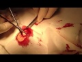 Epidermoid (sebaceous) cyst excision)