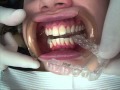 Getting Invisalign in Narberth (Lower Merion) and Blue Bell PA by Orthodontist Dr David Markowitz