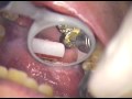 This procedure was performed as an economical treatment alternative to remaking a four tooth bridge. The bridge will be monitored over time for any changes in marginal integrity. Feel free to contact me for information on microscope use and the techniques expressed in this video at mailbox@gcuomodds.com or call 561-391-6290.