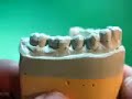 #18 Lower Molar (Porcelain Fused to Metal)