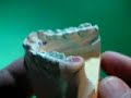 #18 Lower Molar (Porcelain Fused to Metal) Bisq. Bk. #18 Lower Molar (Porcelain Fused to Metal) Bisq. Bk.