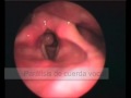 Lesiones en cuerdas vocales y laringe