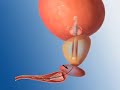 Urethral Catheter and Prostatic Stent overview