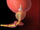 Urethral Catheter and Prostatic Stent overview