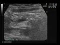 chr pancreatitis