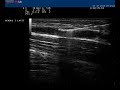 Sclerotherapy Biosound Esaote MyLab, Foam, Ultrasound Guided Sclerotherapy Biosound Esaote MyLab, Foam, Ultrasound Guided
