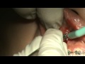 Upper Anterior Skeletal Anchorage Placement, Part 1, Vertical Incision