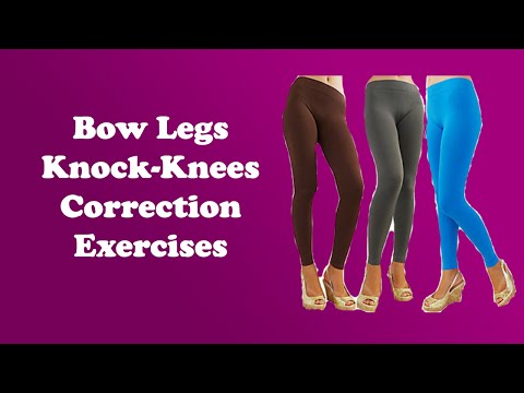 how to cure knock knees
