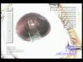 IOL Insertion - Cataract Surgery