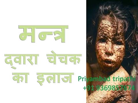 how to cure smallpox