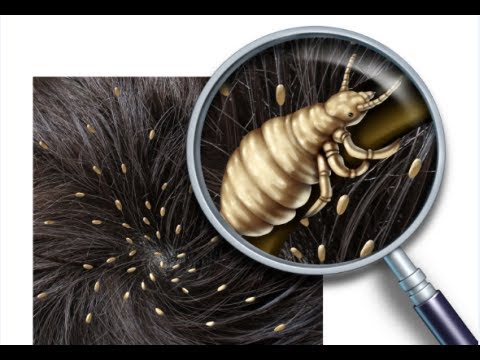 how to check yourself for lice