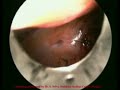 pembedahan laparoscopy myomectomy