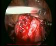 pembedahan laparoscopy myomectomy