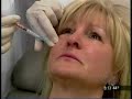 ArteFill - Amazing new wrinkle filler