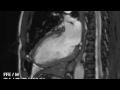 YouTube - 6 days after revascularization of inferior wall ...