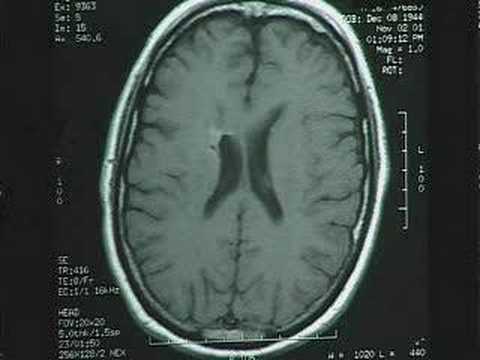 Lymphoma of the Brain - Part 3