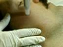 Microdermabrasion Microdermabrasion
