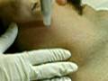 Microdermabrasion