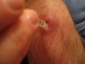 Home Cyst Cleaning H2O2