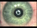 My Eye Sugery My Eye Sugery