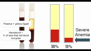 Anemia