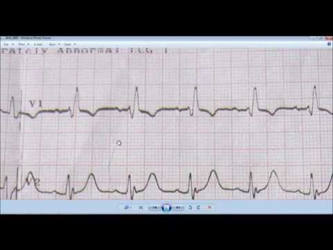 how to treat rbbb