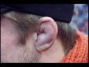CAULIFLOWER EAR.wmv