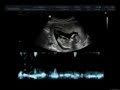 Ultrasom de Lara, filha amada de Alexandre e Mariana