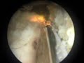 PVP - Photoselective vaporization of the prostate PVP - Photoselective vaporization of the prostate