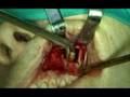 maxillofacial surgery video preview 10
