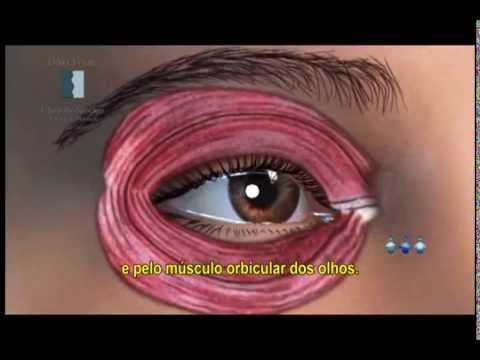 Video Pálpebra Oriental (Blefaroplastia)