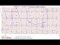 ECG Interpretation, Limitations Of ECG/Artifacts, Part 4-4