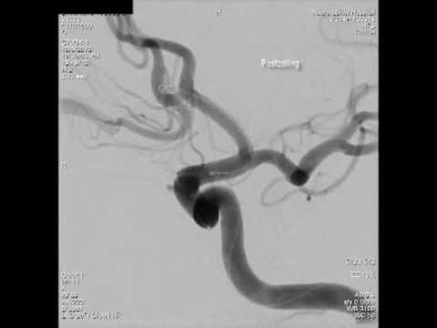micro catheter - ENDOVASCULAR COILING OF VERY SMALL RECURRENT ACom ANEURYSM: 38 year male, presented with history of severe headache, 3 days prior to admission. At the time o...