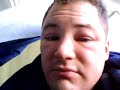 Frosty the snowman blogs about dermatitis Frosty the snowman blogs about dermatitis
