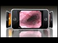 Barrett Esophagus Endoscopic Animation