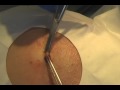 Scalp Cyst Removal