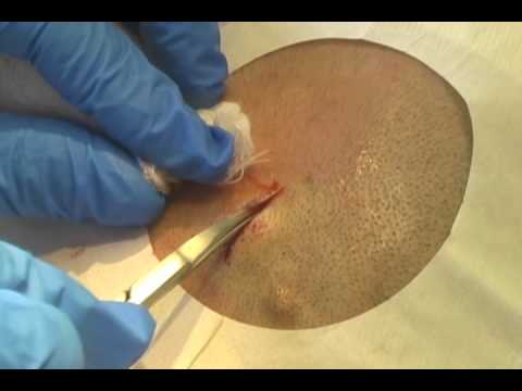 how to drain cyst on scalp