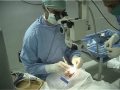 PHACO Surgery.MPG
